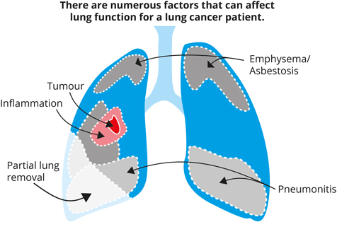 Lung Definition & Image